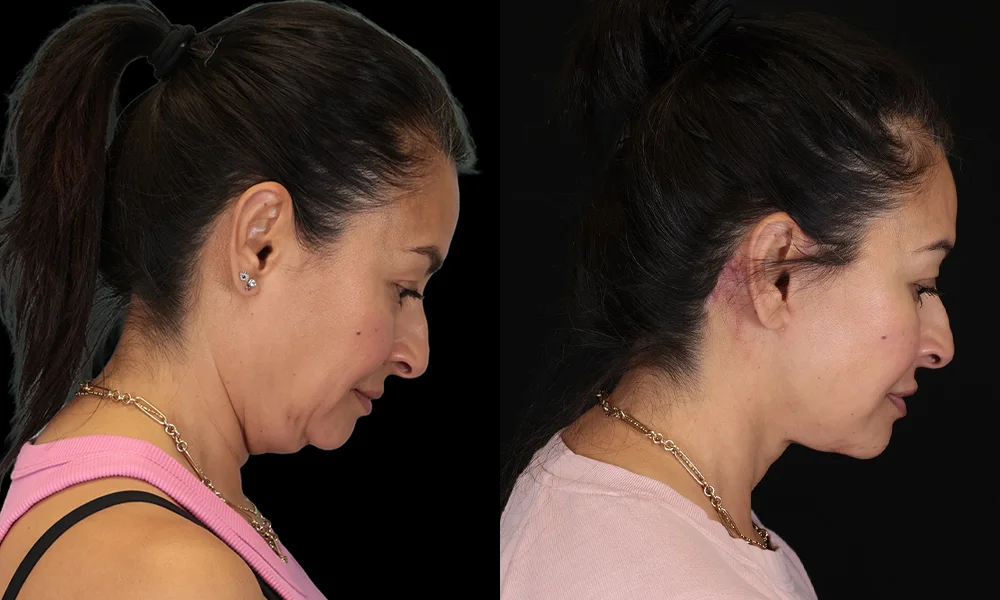 Real patient results in New York, NY Performed by Sameer Halani, MD