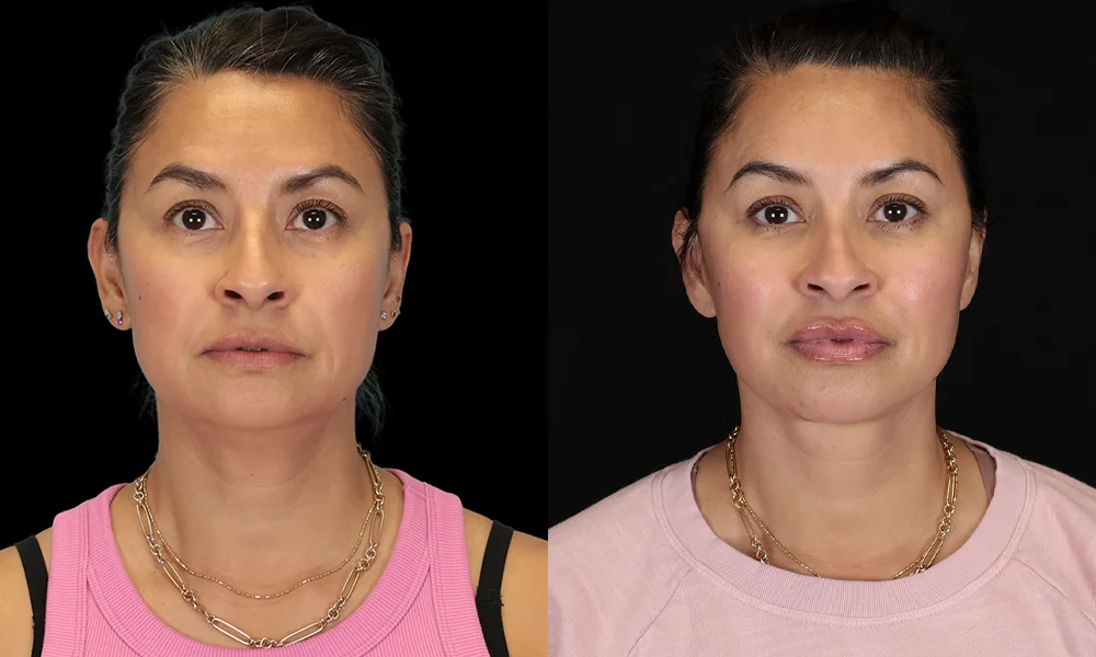 Real patient results in New York, NY Performed by Sameer Halani, MD