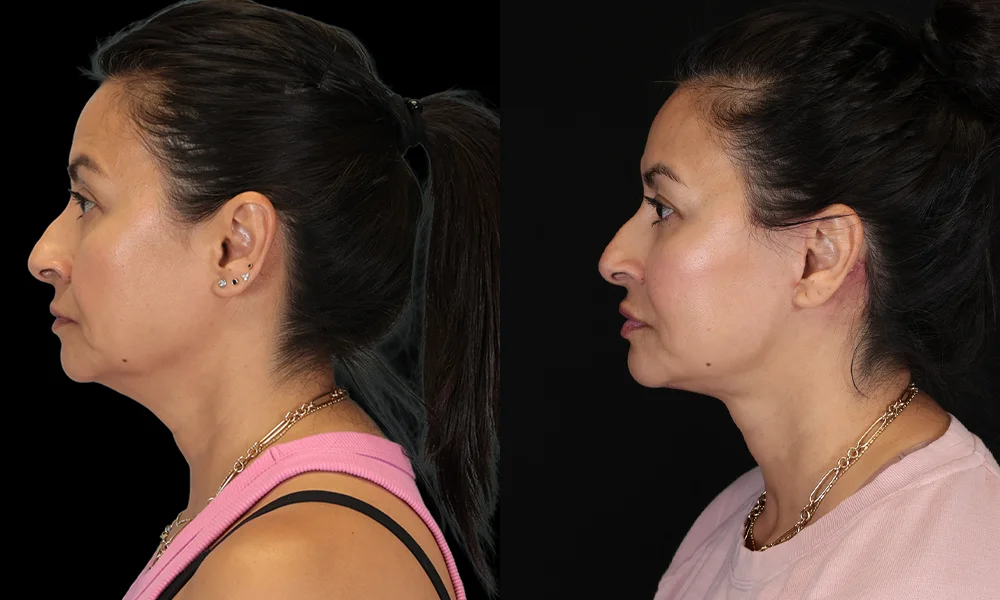 Real patient results in New York, NY Performed by Sameer Halani, MD