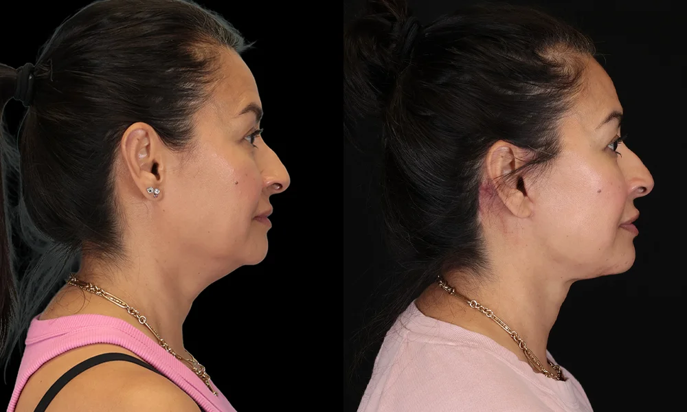 Real patient results in New York, NY Performed by Sameer Halani, MD