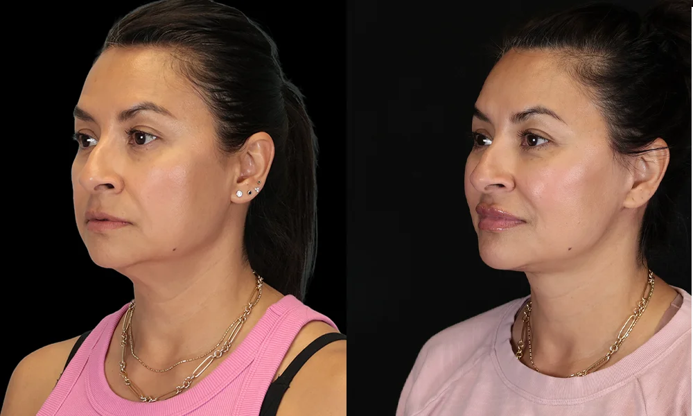 Real patient results in New York, NY Performed by Sameer Halani, MD