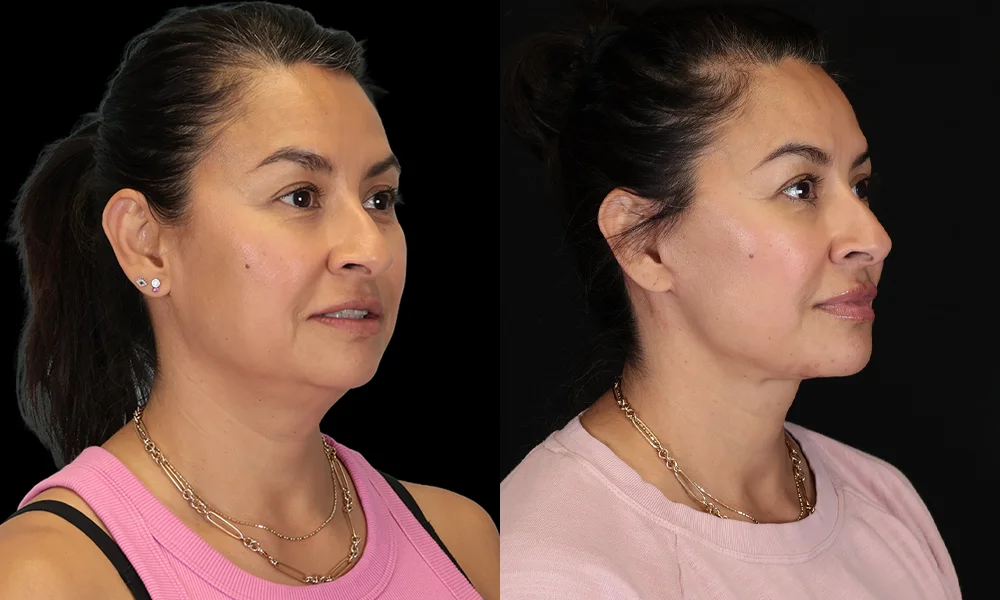 Real patient results in New York, NY Performed by Sameer Halani, MD