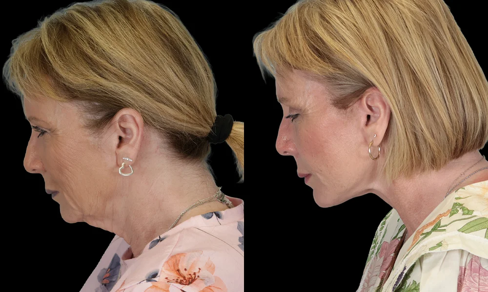 Real patient results in New York, NY Performed by Sameer Halani, MD