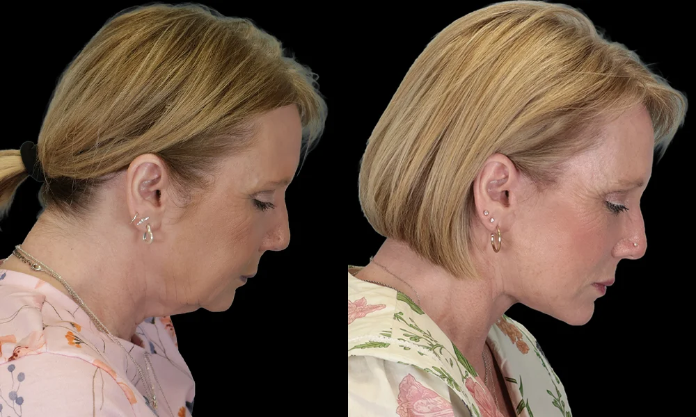 Real patient results in New York, NY Performed by Sameer Halani, MD