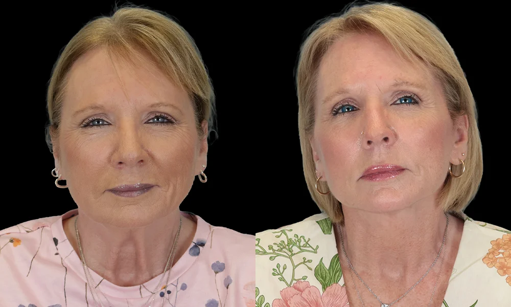 Real patient results in New York, NY Performed by Sameer Halani, MD
