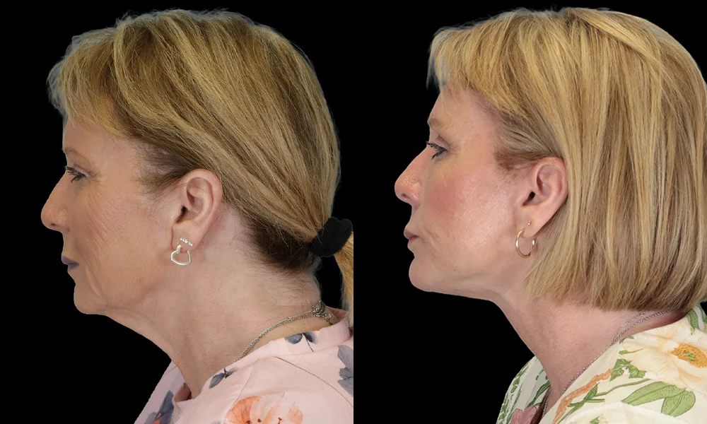 Real patient results in New York, NY Performed by Sameer Halani, MD