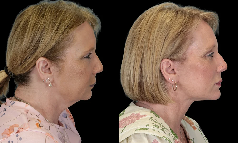 Real patient results in New York, NY Performed by Sameer Halani, MD