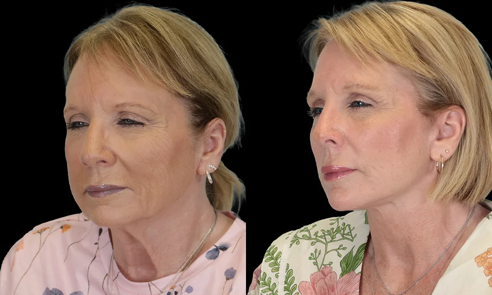 Real patient results in New York, NY Performed by Sameer Halani, MD