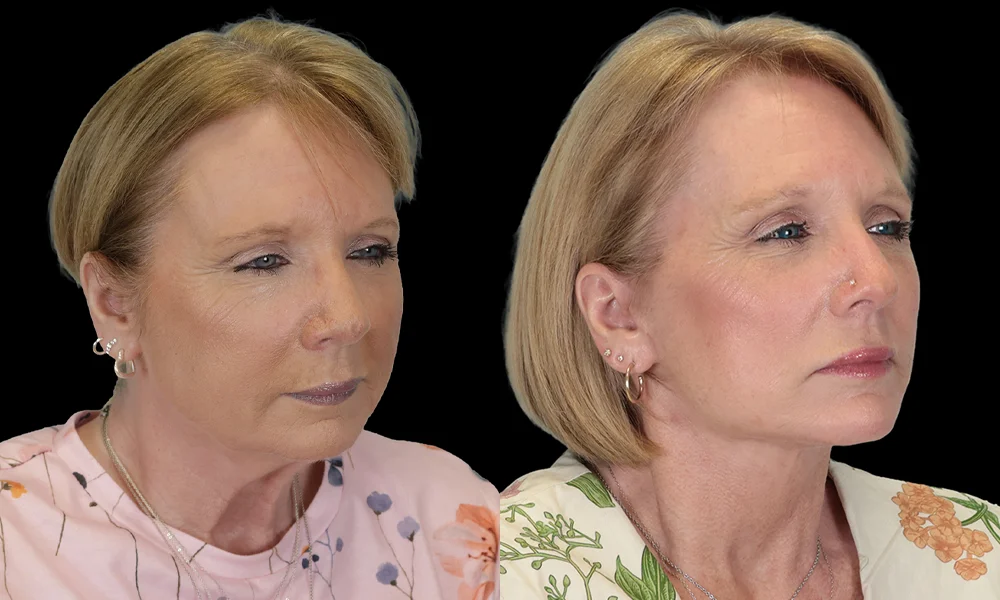 Real patient results in New York, NY Performed by Sameer Halani, MD
