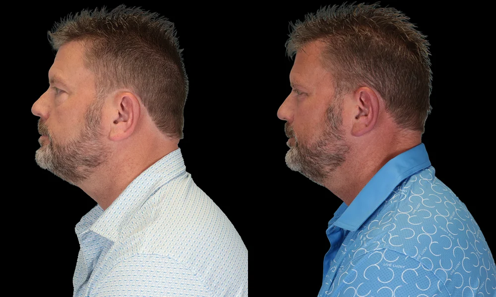 Real patient results in New York, NY Performed by Sameer Halani, MD