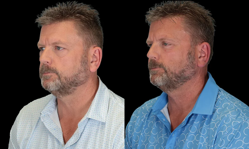 Real patient results in New York, NY Performed by Sameer Halani, MD