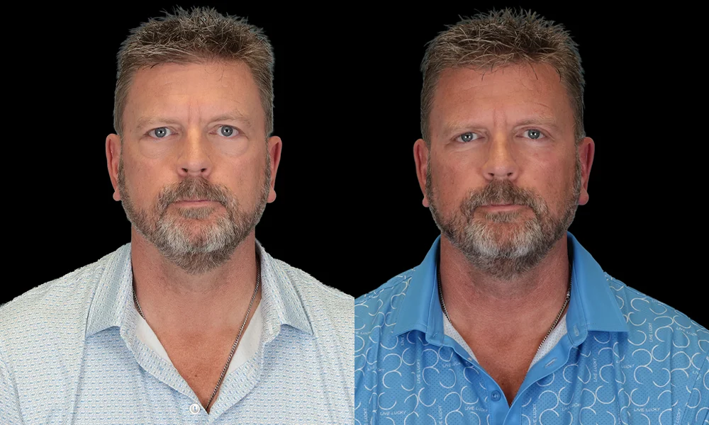 Real patient results in New York, NY Performed by Sameer Halani, MD