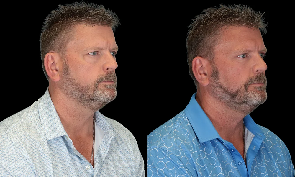 Real patient results in New York, NY Performed by Sameer Halani, MD