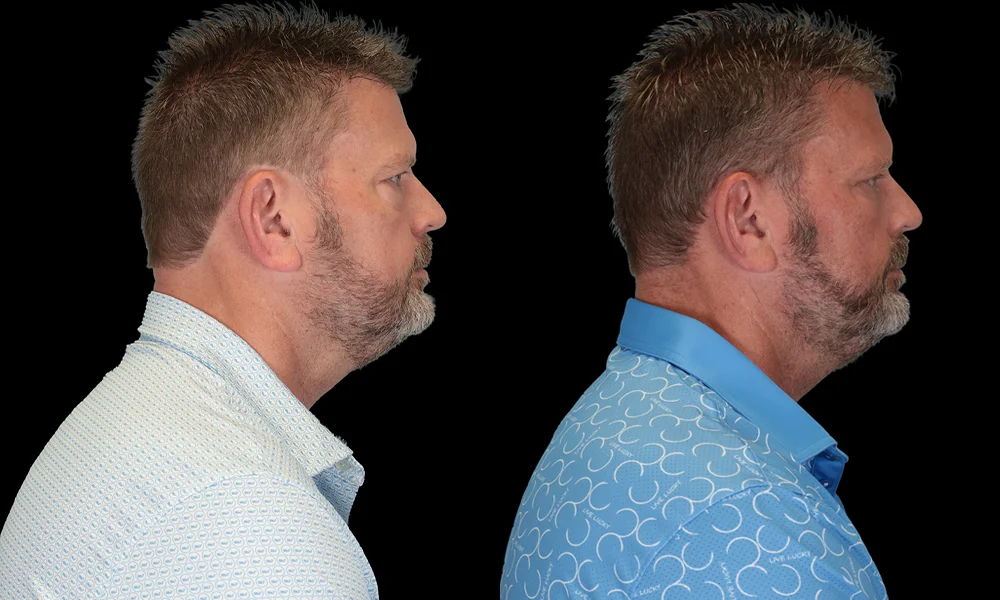 Real patient results in New York, NY Performed by Sameer Halani, MD