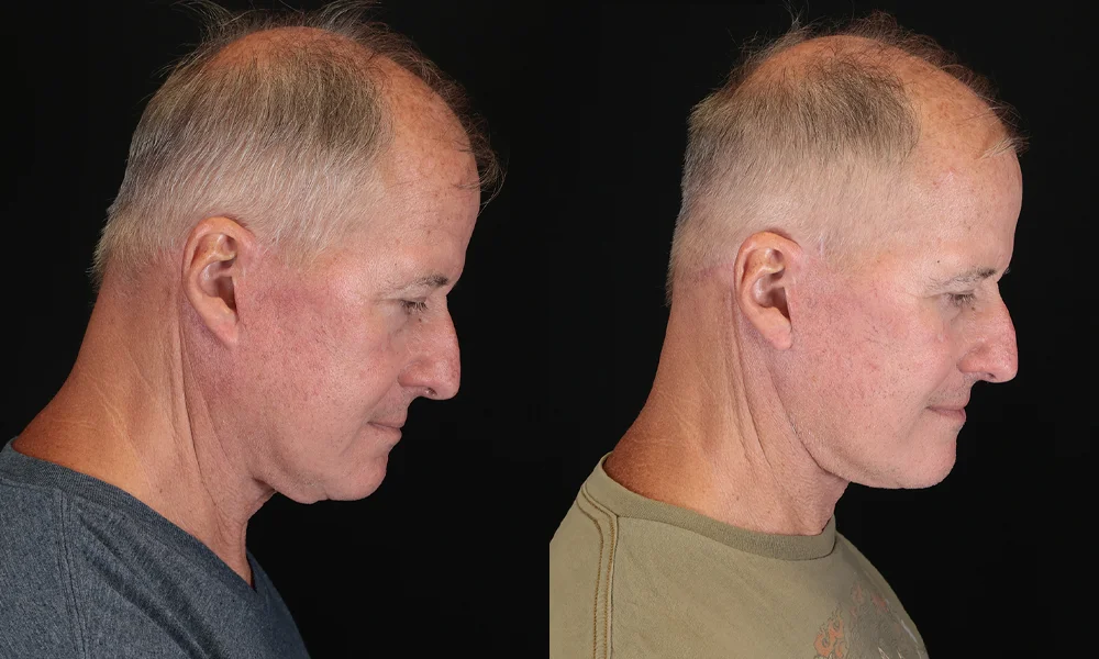 Real patient results in New York, NY Performed by Sameer Halani, MD
