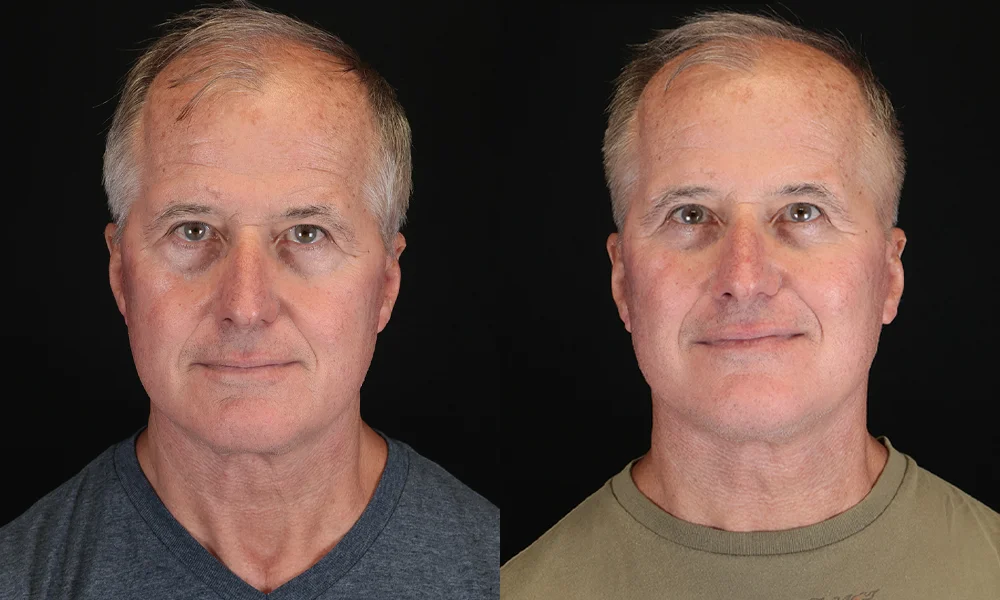 Real patient results in New York, NY Performed by Sameer Halani, MD