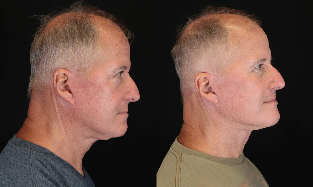 Real patient results in New York, NY Performed by Sameer Halani, MD