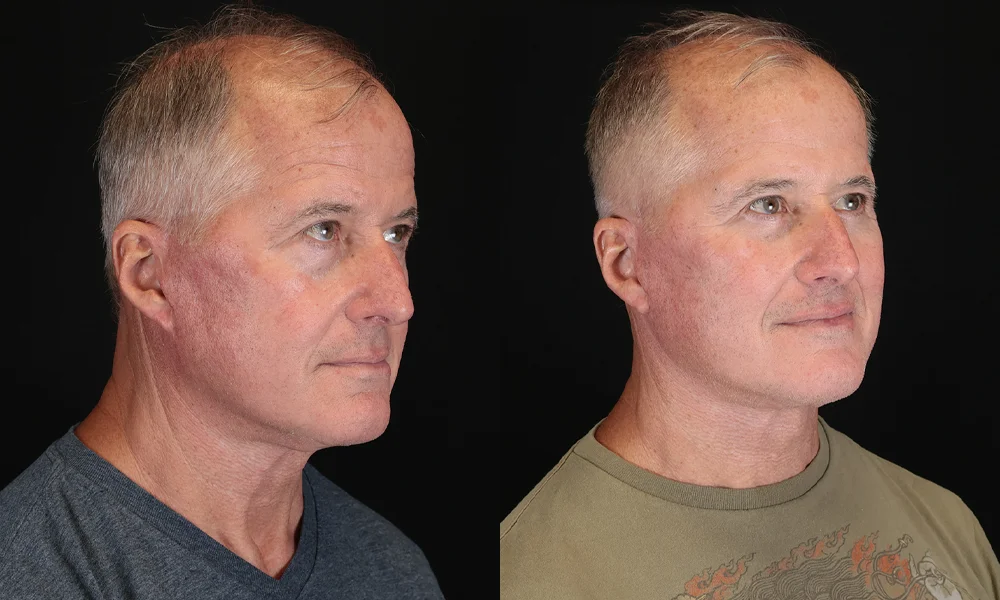 Real patient results in New York, NY Performed by Sameer Halani, MD