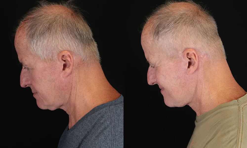 Real patient results in New York, NY Performed by Sameer Halani, MD