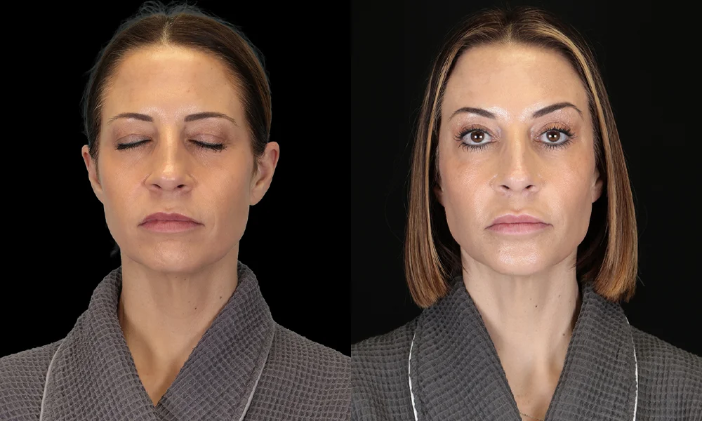 Real patient results in New York, NY Performed by Sameer Halani, MD