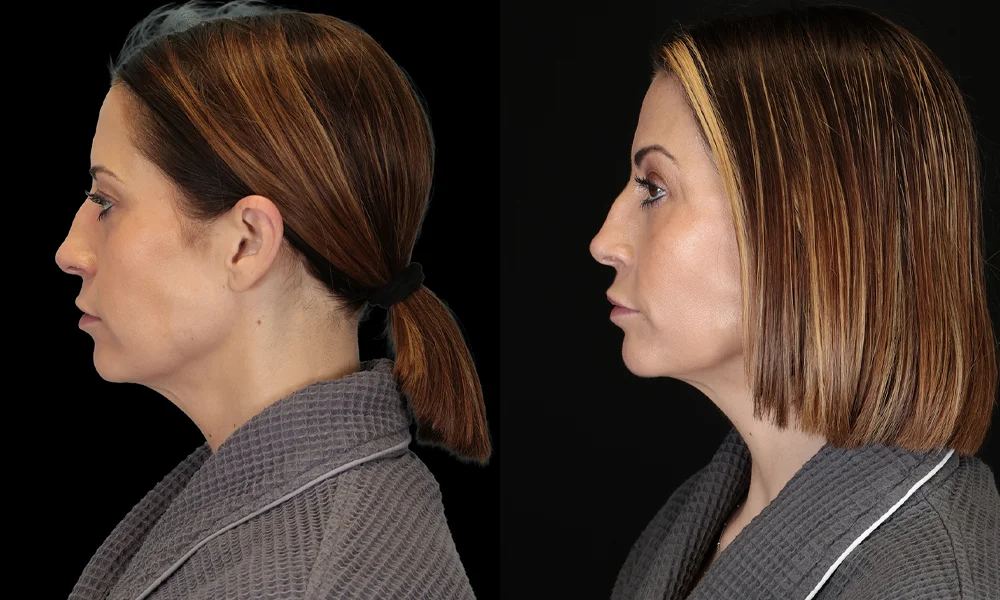 Real patient results in New York, NY Performed by Sameer Halani, MD