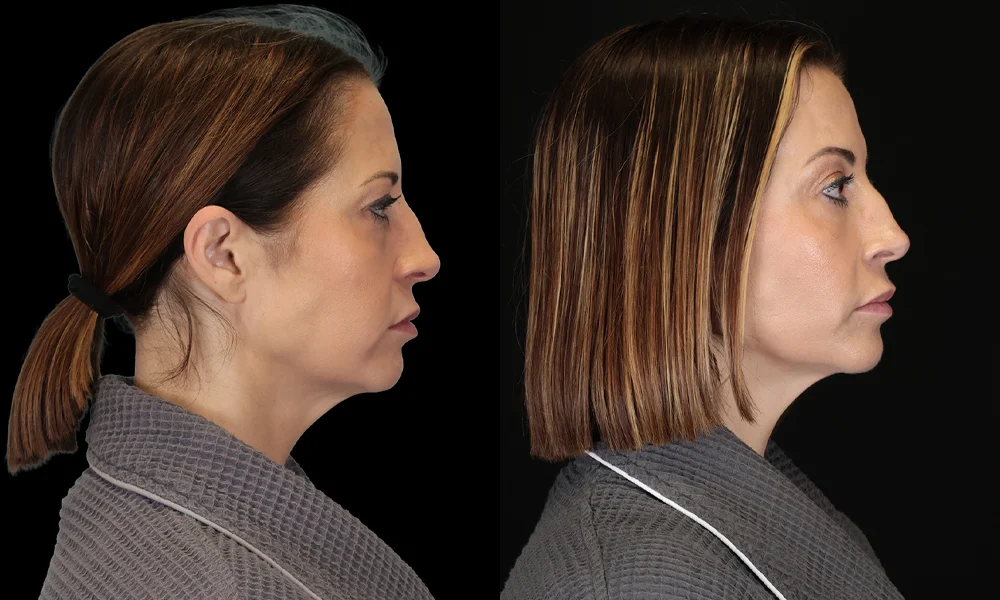 Real patient results in New York, NY Performed by Sameer Halani, MD
