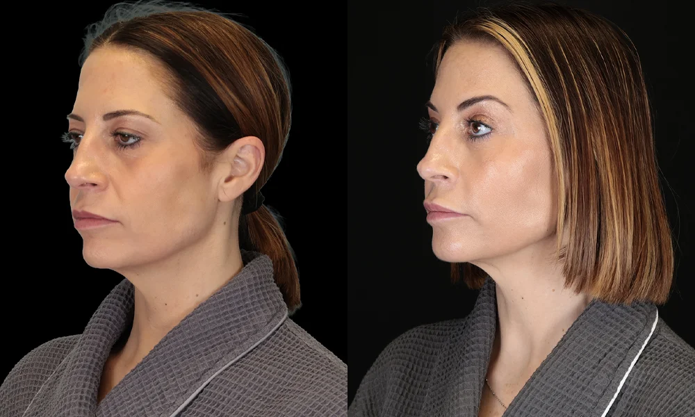 Real patient results in New York, NY Performed by Sameer Halani, MD