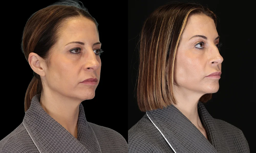 Real patient results in New York, NY Performed by Sameer Halani, MD