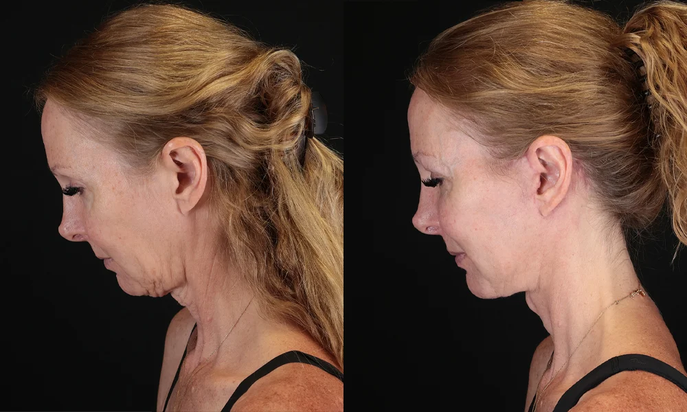 Real patient results in New York, NY Performed by Sameer Halani, MD