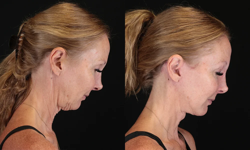 Real patient results in New York, NY Performed by Sameer Halani, MD