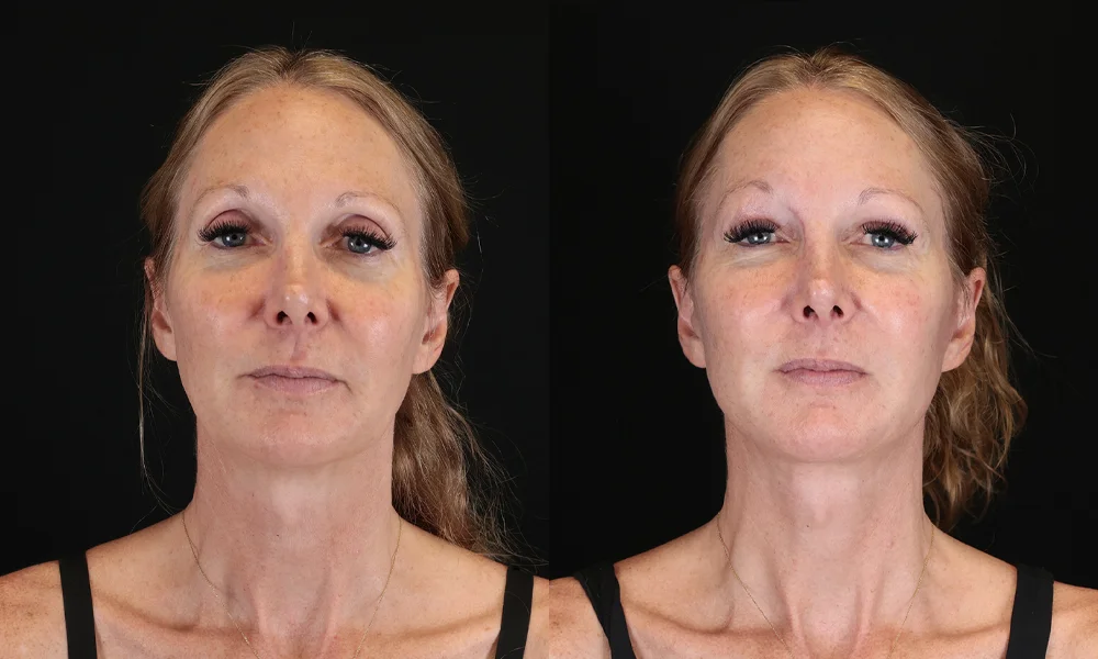 Real patient results in New York, NY Performed by Sameer Halani, MD