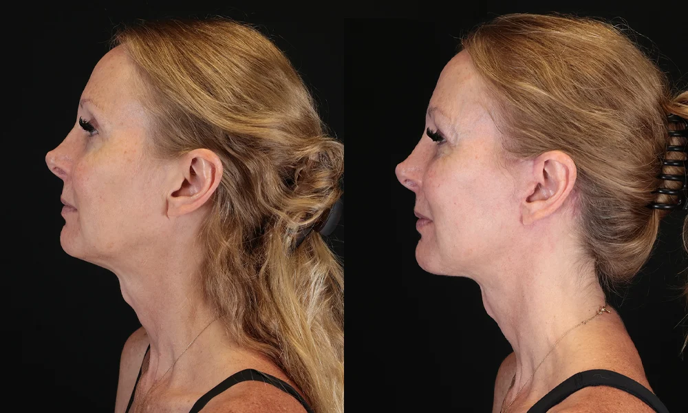 Real patient results in New York, NY Performed by Sameer Halani, MD