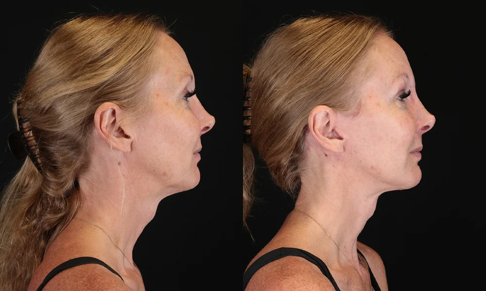 Real patient results in New York, NY Performed by Sameer Halani, MD