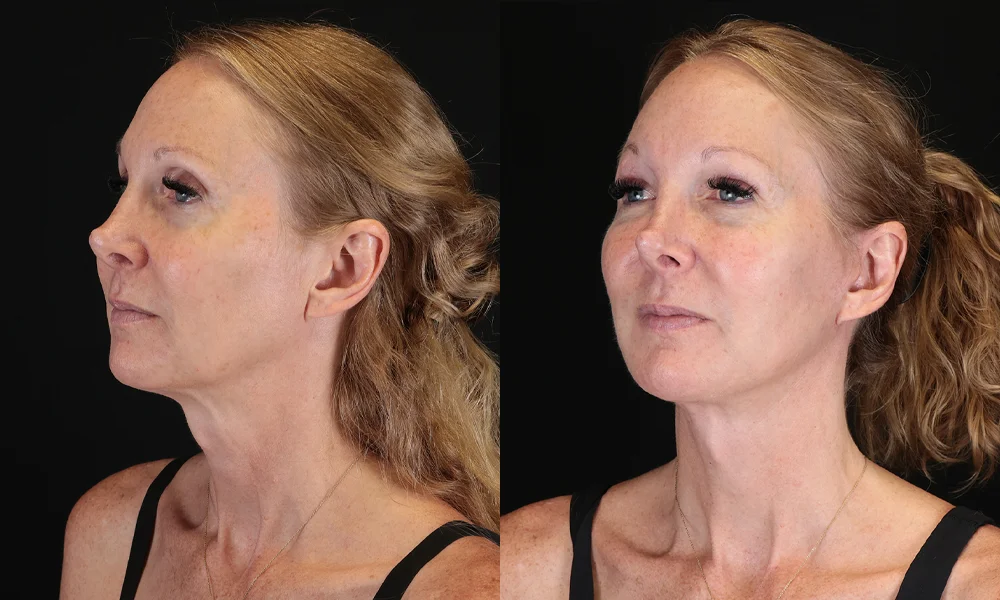 Real patient results in New York, NY Performed by Sameer Halani, MD