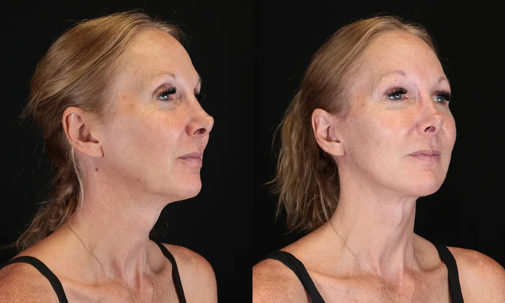 Real patient results in New York, NY Performed by Sameer Halani, MD