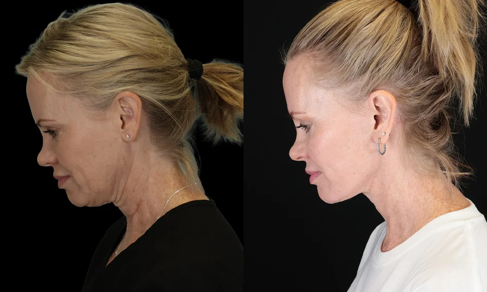 Real patient results in New York, NY Performed by Sameer Halani, MD