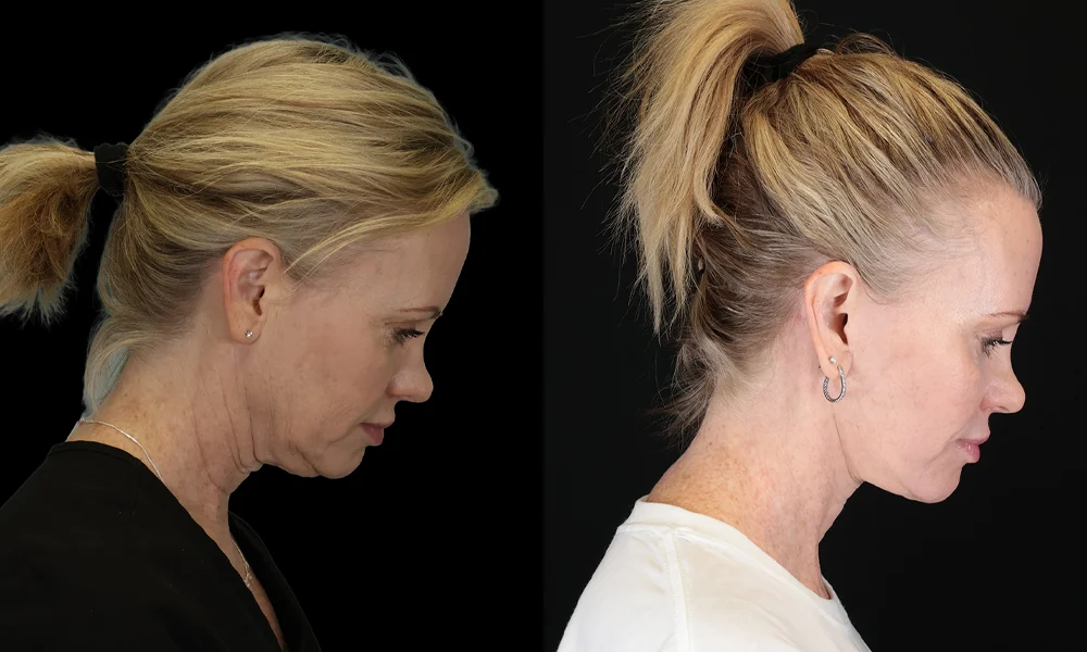 Real patient results in New York, NY Performed by Sameer Halani, MD