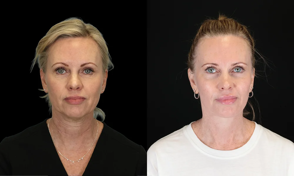 Real patient results in New York, NY Performed by Sameer Halani, MD