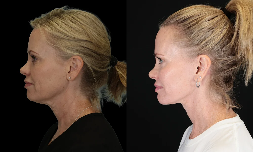 Real patient results in New York, NY Performed by Sameer Halani, MD