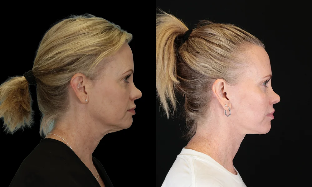 Real patient results in New York, NY Performed by Sameer Halani, MD