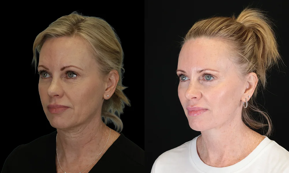 Real patient results in New York, NY Performed by Sameer Halani, MD