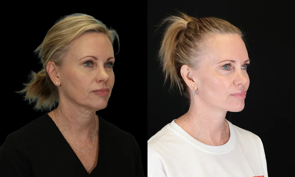 Real patient results in New York, NY Performed by Sameer Halani, MD