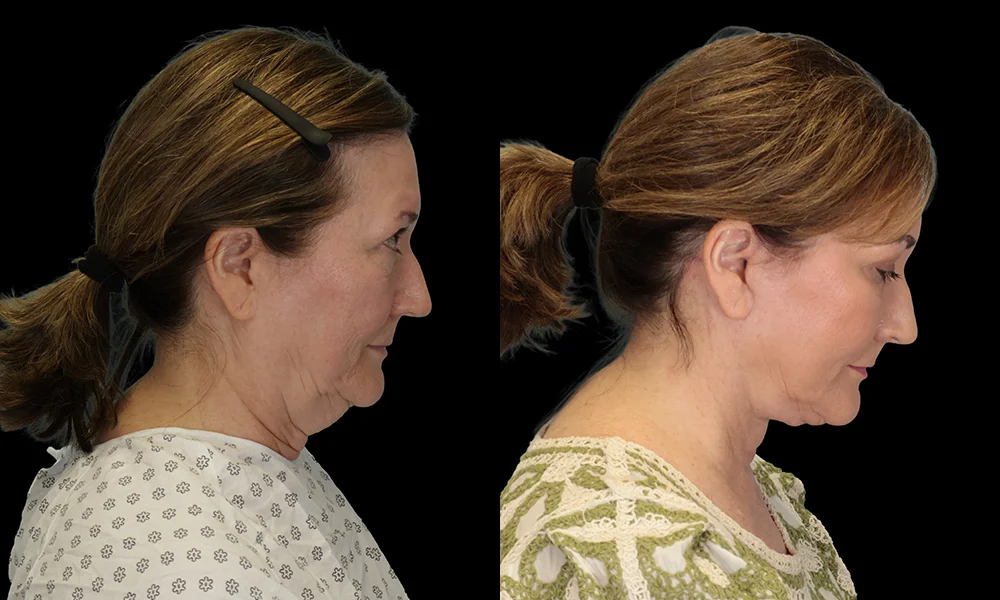 Real patient results in New York, NY Performed by Sameer Halani, MD