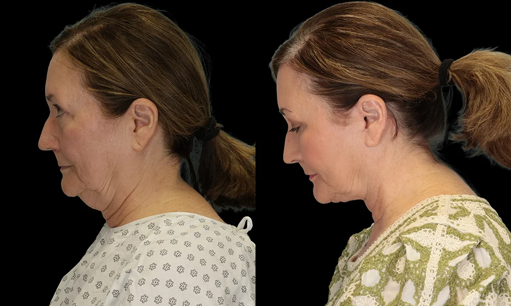 Real patient results in New York, NY Performed by Sameer Halani, MD