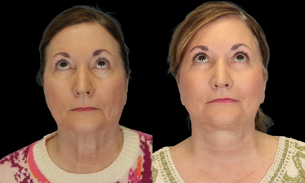 Real patient results in New York, NY Performed by Sameer Halani, MD