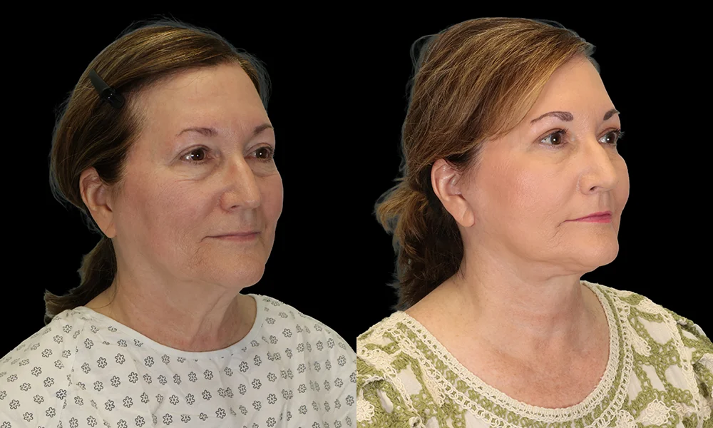 Real patient results in New York, NY Performed by Sameer Halani, MD