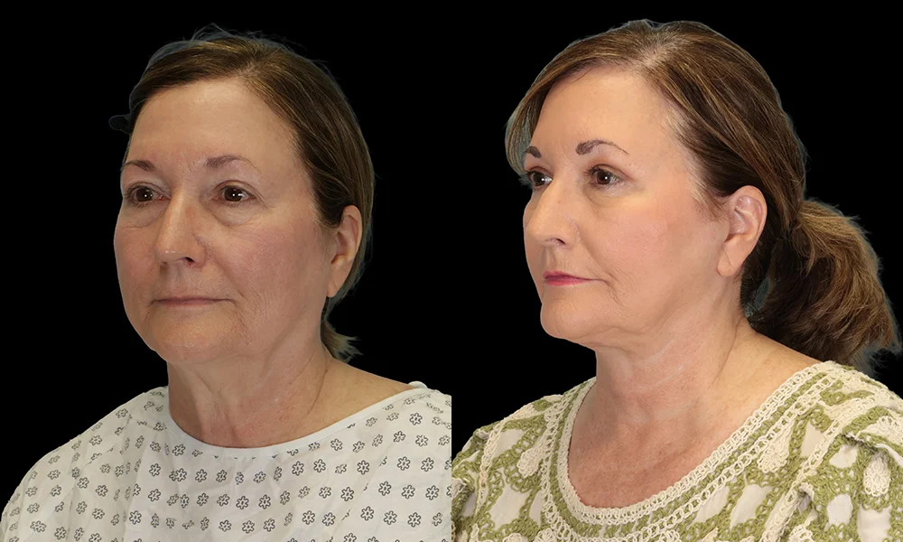 Real patient results in New York, NY Performed by Sameer Halani, MD