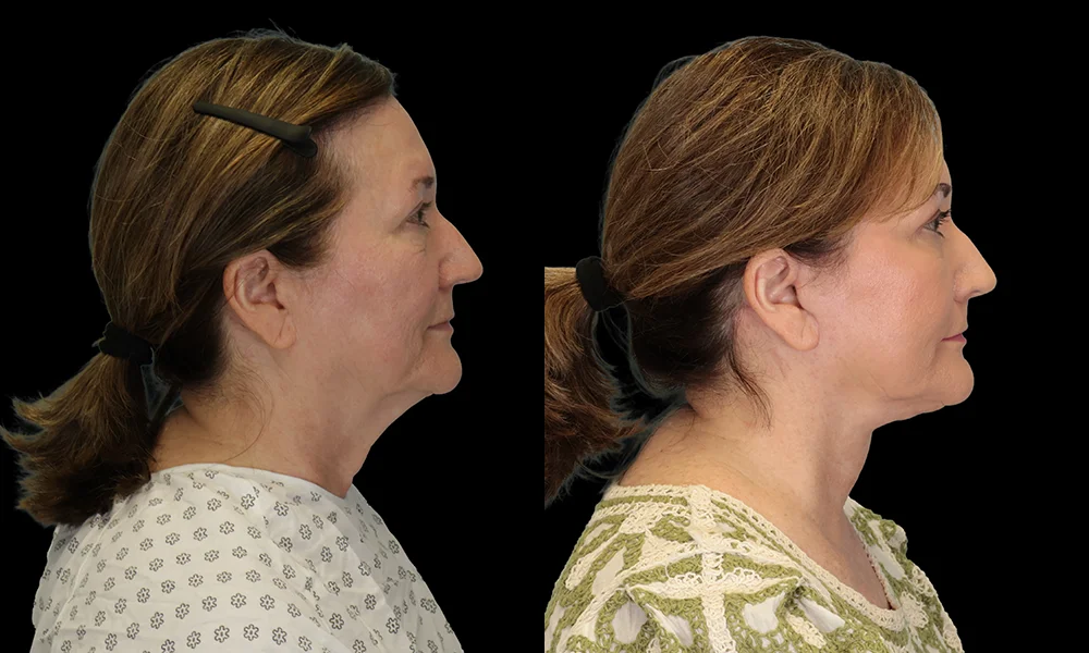Real patient results in New York, NY Performed by Sameer Halani, MD