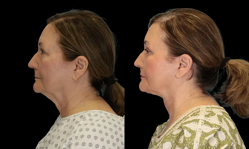 Real patient results in New York, NY Performed by Sameer Halani, MD