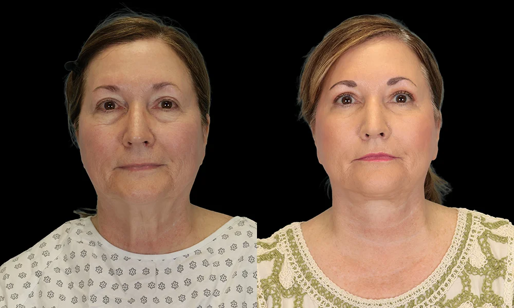 Real patient results in New York, NY Performed by Sameer Halani, MD